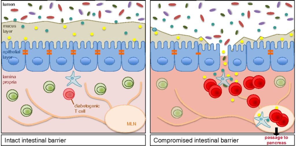 Leaky Gut Syndrome