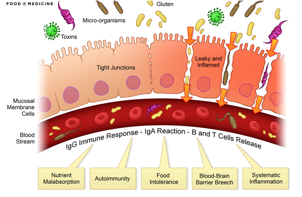 Leaky Gut Syndrome