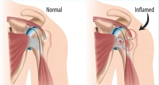 shoulder Bursitis